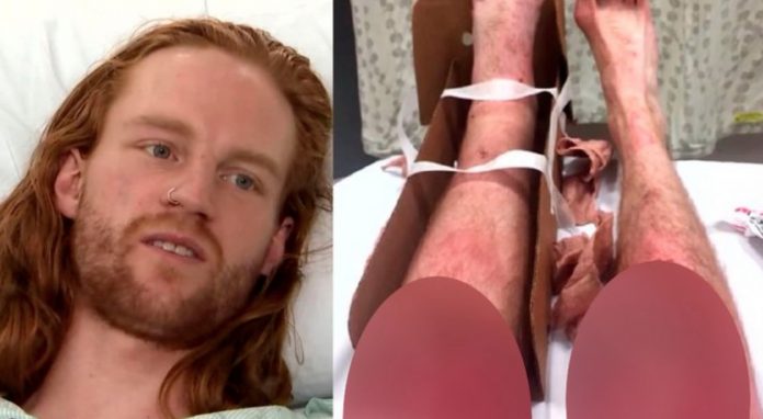 В США бегун сломал ногу и 11 часов по снегу полз за помощью